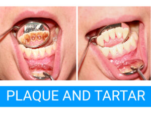 tartar between teeth