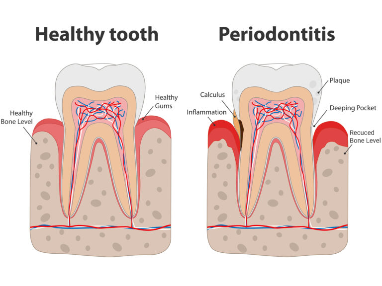 what-is-a-periodontal-pocket