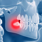 Can Wisdom Teeth Cause Sinus Pain & Problems?