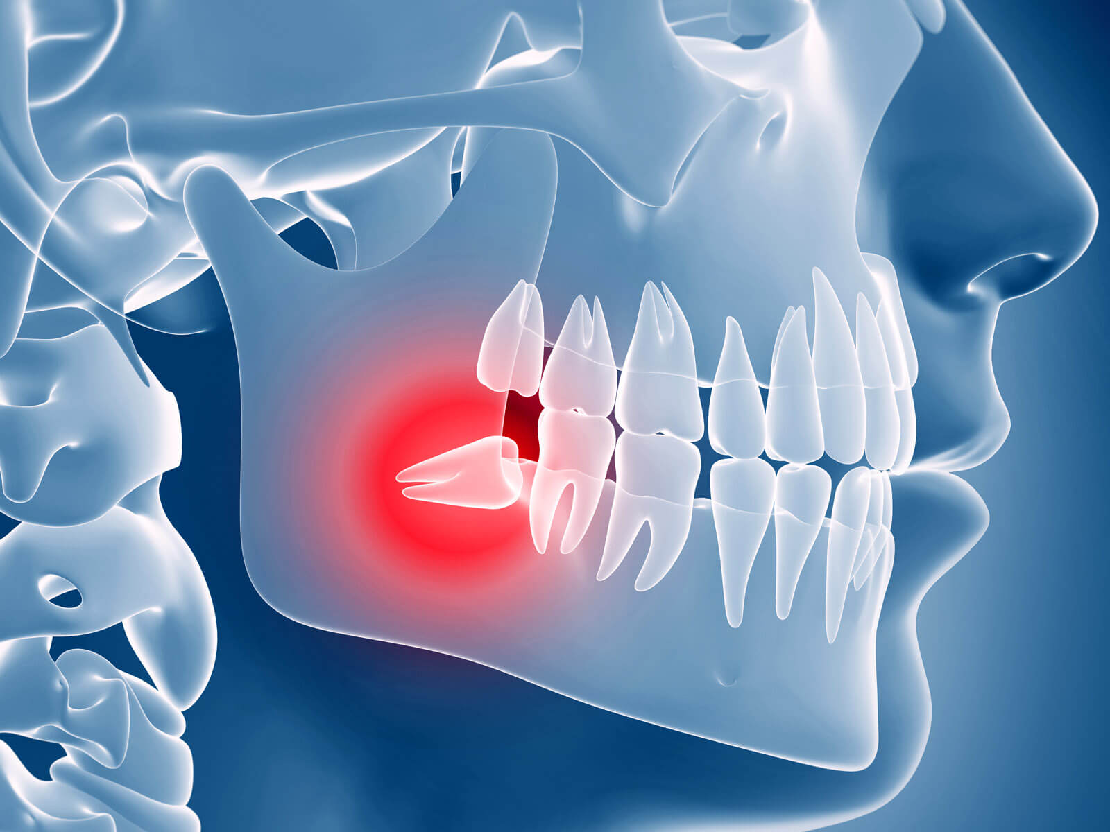 Can Wisdom Teeth Cause Sinus Pain & Problems?