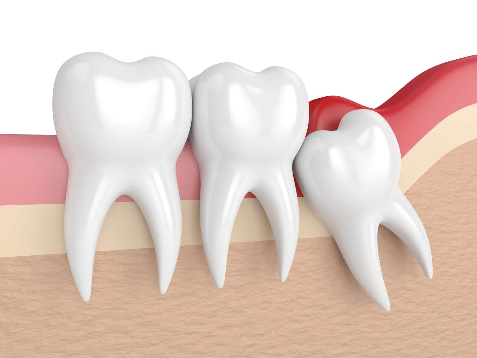 Signs Your Wisdom Teeth Should Be Extracted