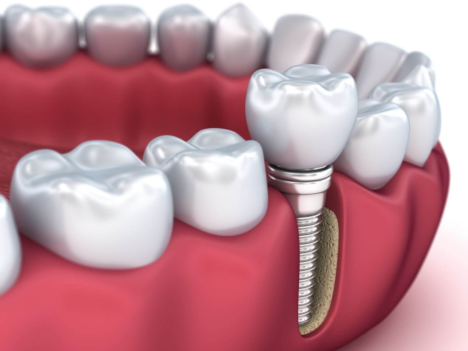 Titanium Implant Side Effects And How To Minimize Your Risk